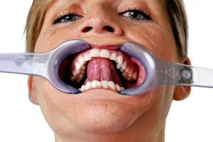 A woman s mouth is wide open, and a metal clamp is being used to hold her teeth apart.