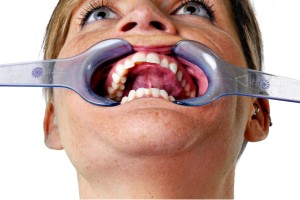 An individual wearing a dental impression tray over their mouth, showing teeth and tongue.